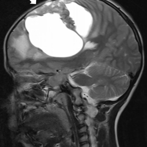 3812. Мальчику 1 года с жалобами на острую правостороннюю моторную слабость выполнена магнитно-резонансная томография, необходимо дифференцировать выявленную рентгенологическую картину с