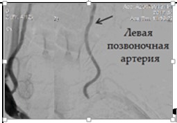 1660. На представленной ангиографии отражен