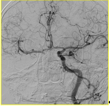 1700. На представленной ангиографии интракраниального отдела левой вса можно предположить