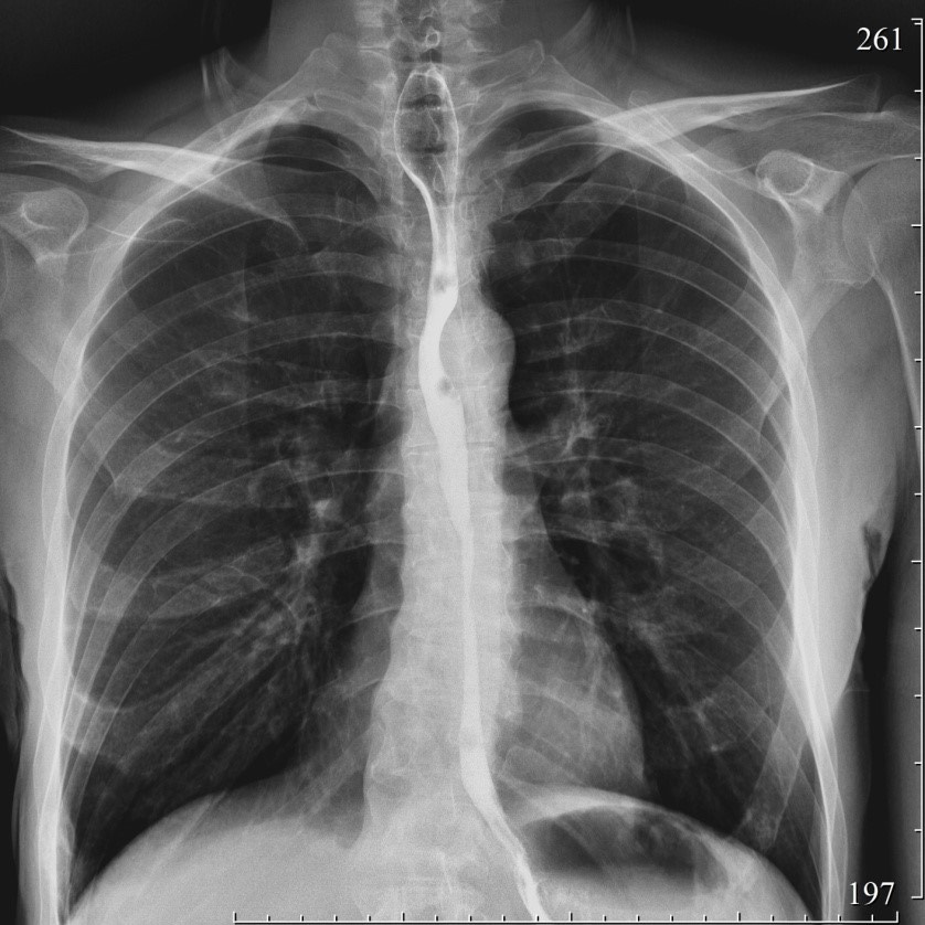 2178. При проведении контрастной рентгеноскопии пищевода с бариевой взвесью определяется