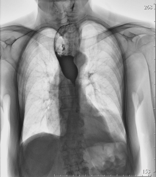 2185. Из анамнеза известно, что в течение длительного времени пациент страдает тяжелым рефлюкс-эзофагитом, осложнившимся развитием