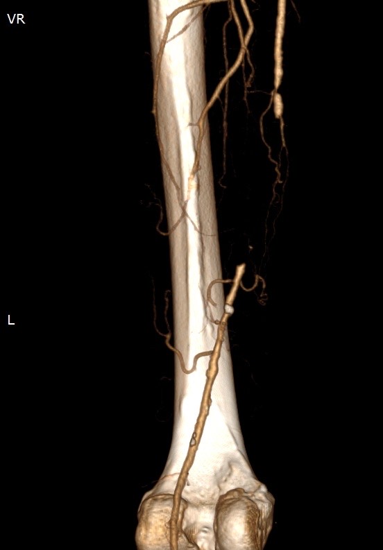 2186. Для лечения пациента с хронической окклюзией пба слева (снимок мскт), клиникой перемежающей хромоты, хинк iib рекомендуется
