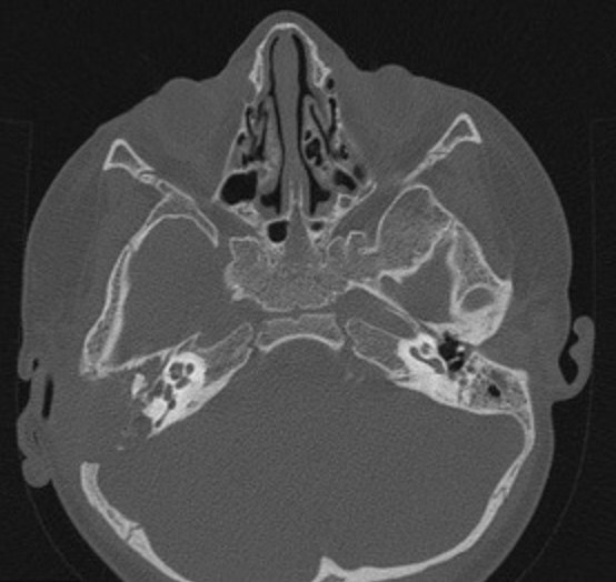 1966. У пациента с выявленными на компьютерной томограмме множественными рентгенопрозрачными очагами в костях основания черепа, плохо отграниченными от окружающих тканей, вероятной природой изменений считают