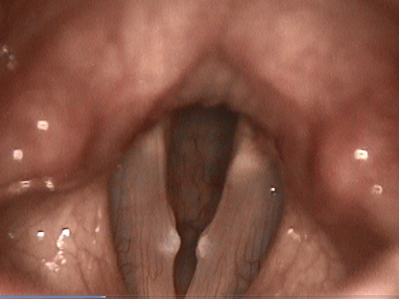 2240. Данная ларингоскопическая картина позволяет поставить диагноз