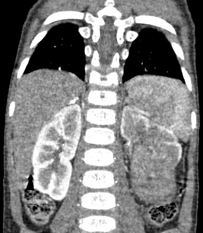 1387. Пациенту 4 лет с жалобами на кровь в моче, увеличение живота в размерах, снижением веса в течение месяца выполнена компьютерная томография, патологическим процессом, соответствующим клинико-рентгенологической картине считают опухоль
