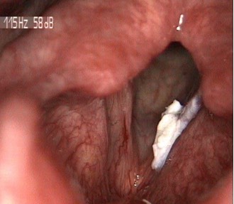 2606. Пациенту с данной ларингоскопической картиной необходимо провести