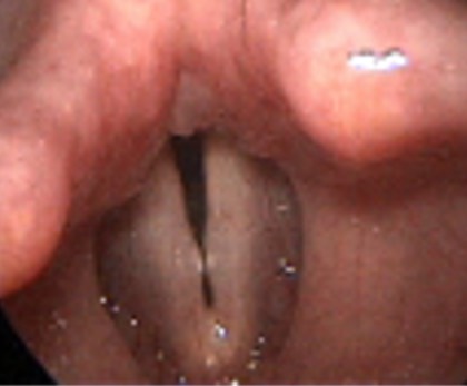 2636. Данная ларингеальная картина характеризует