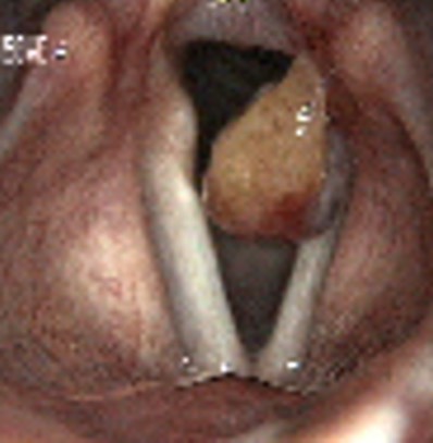 2643. Данная ларингеальная картина характеризует