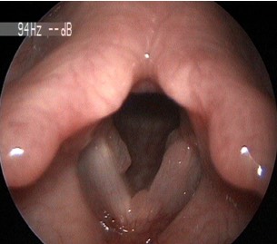 2654. Данная ларингеальная картина характеризует