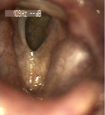 2681. Данная ларингеальная картина характеризует