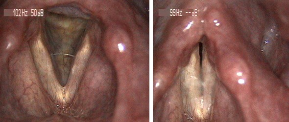 2711. Пациенту с данной ларингеальной картиной показано проведение