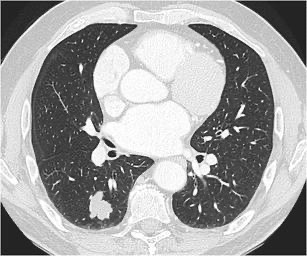 2396. Учитывая представленные на томографическом срезе данные и локализацию первичного железистого рака в паренхиме лёгкого у пациента, состоящего на диспансерном учёте по поводу хронической обструктивной болезни лёгких с объёмом форсированного выдоха за 1 секунду 60% от должного и стабильной стенакардии напряжения функциональный класс ii, целесообразно выполнение видеоторакоскопической