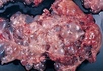 1762. У пациентки 25 лет на 12 неделе беременности развилась протеинурия, гипертензия и отёк лодыжек, показана ткань, выделенная из влагалища, диагнозом является