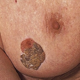 1763. У пациентки 72 лет с жалобами на дискомфорт в области эпигастрия и потерю веса обнаружены на груди и других частях тела образования. причиной симптомов считают