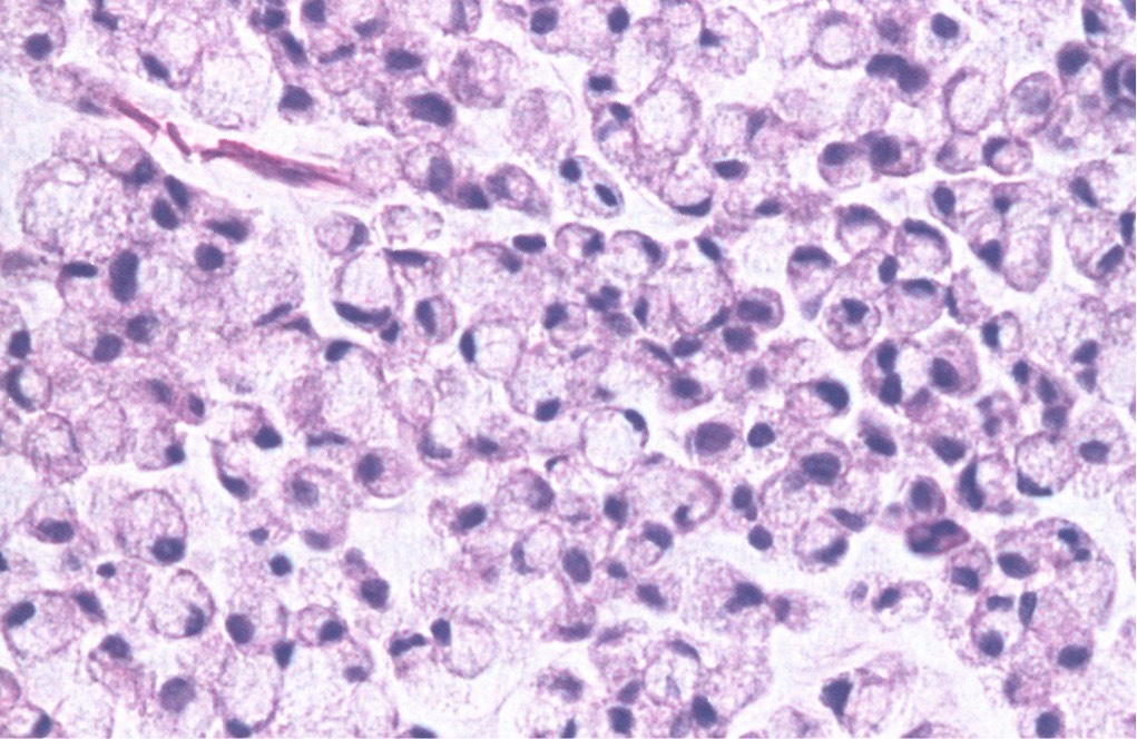 1786. Нозологической единицей, соответствующей данной микроскопической картине опухоли слизистой оболочки желудка, считают