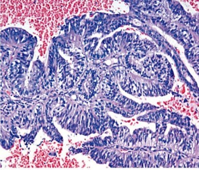 1973. На изображении представлен гистологический тип опухоли, а именно