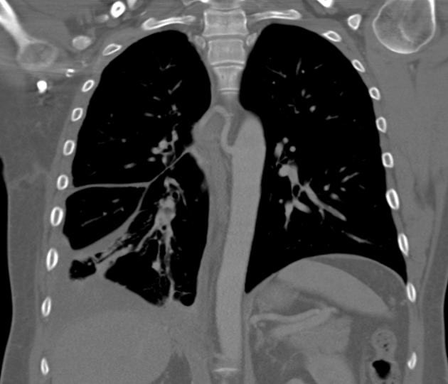 2895. Обнаруженные при компьютерной томографии признаки у пациента, которого беспокоят частые эпизоды правосторонней пневмонии, наиболее характерны для