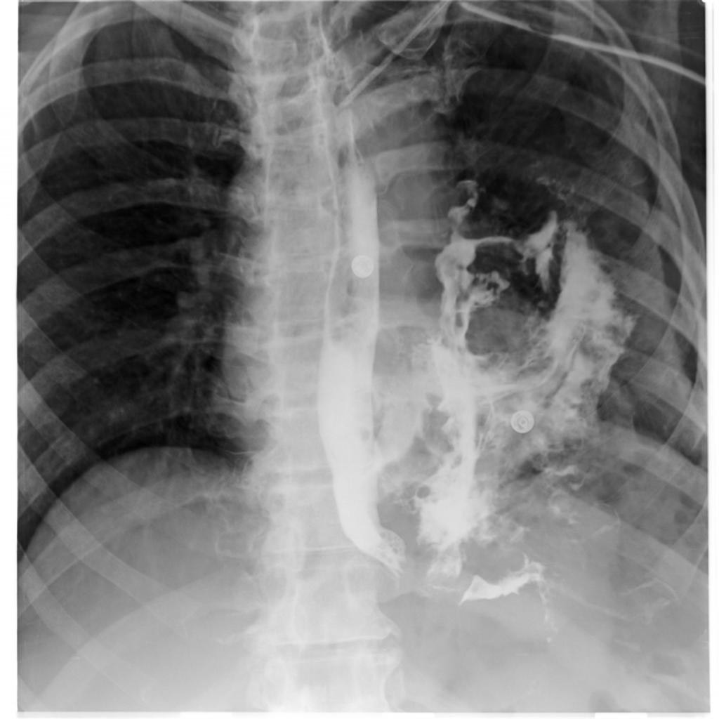 2921. Рентгенологические данные, представленные на снимке грудной клетки пациента после дренирования плевральной полости по поводу пневмоторакса, развившегося на фоне неукротимой рвоты в связи с алкогольной интоксикацией, наиболее вероятно соответствуют клинической картине