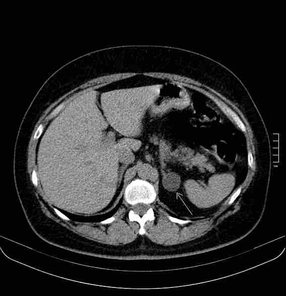 2903. Для того, чтобы предположить природу образования в левом надпочечнике, указанного стрелкой, в первую очередь необходимо